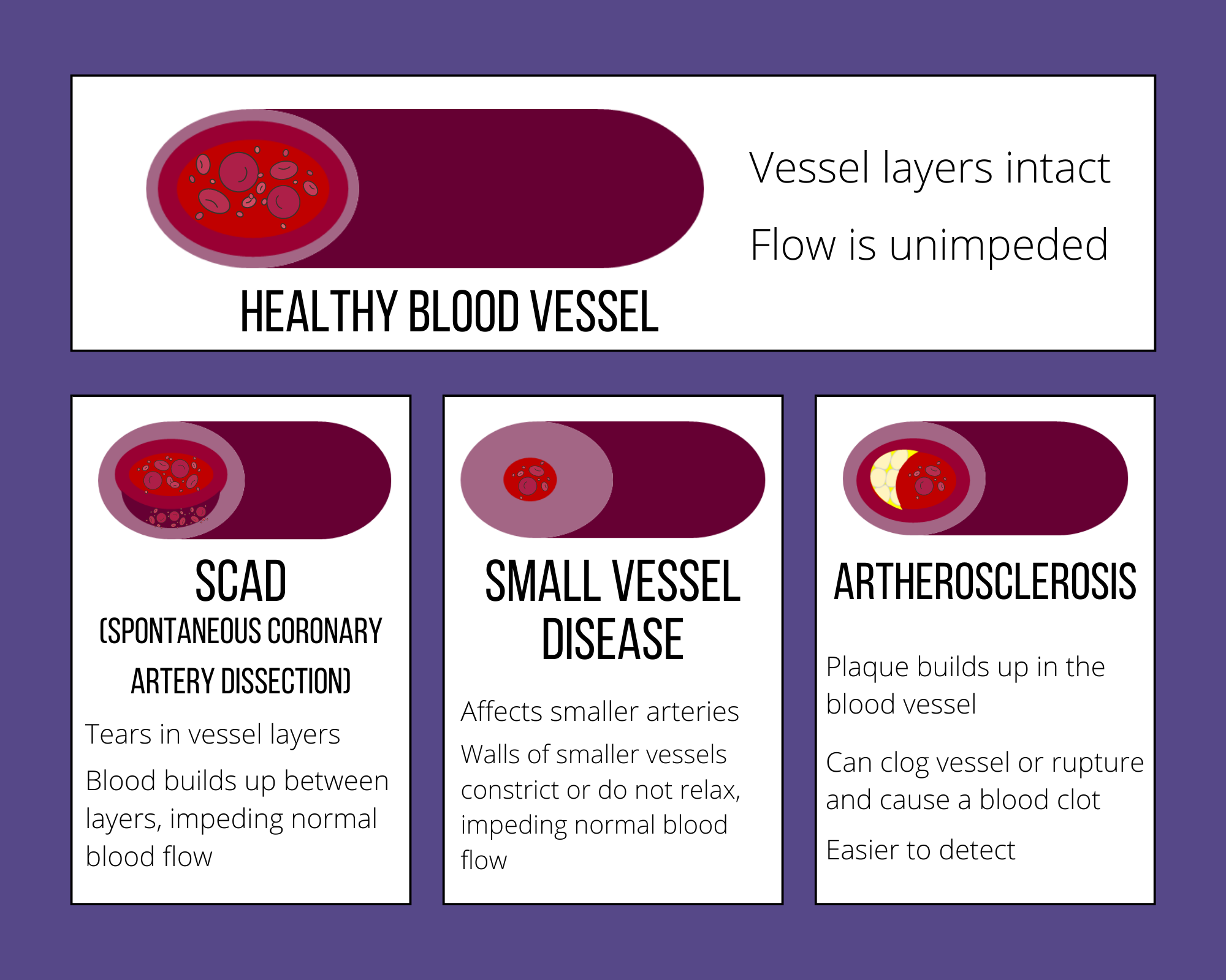 Blood vessel diagram showing causes of a heart attack in women. SCAD and small vessel disease were initially thought to be rare, but are increasingly being found in women