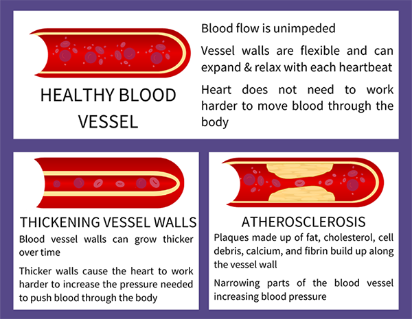 Blood vessel diagram illustrating changes that can happen over time leading to increased blood pressure.