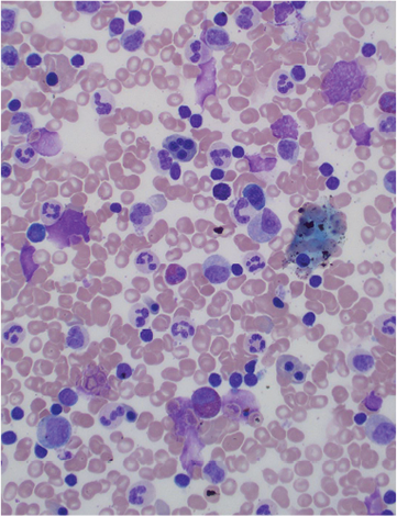 Bone marrow sample (aspirate) showing different types of blood cells. 