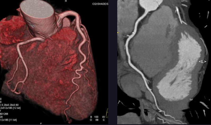 Heart images acquired using CCTA technology. Image from Cardiology Today: The Rise of the Coronary CT Angiogram
