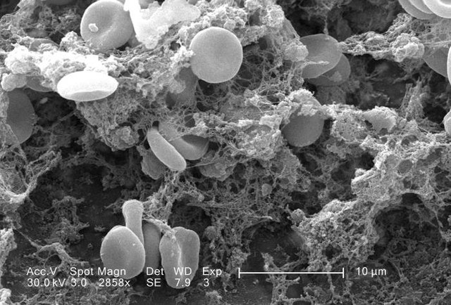 Red blood cells are trapped within fibrin threads. 